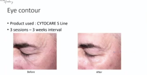 Before and after Cytocare S Line 